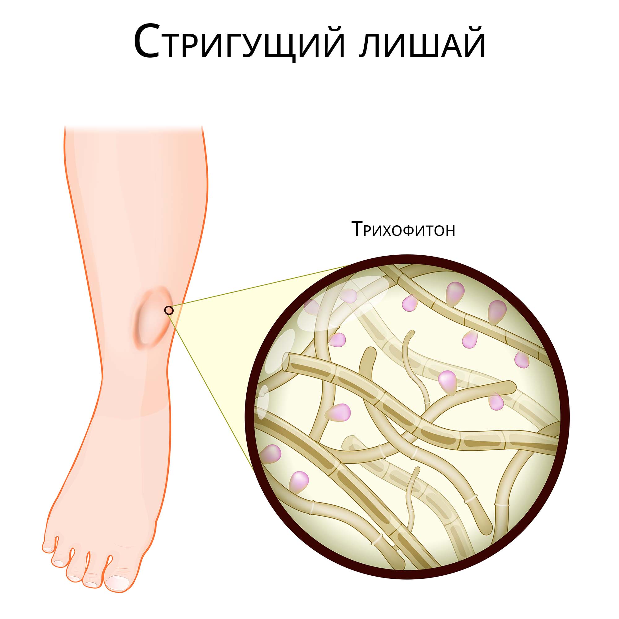 Фолликулярный кератоз после депиляции воском или сахаром - sweettofit.ru